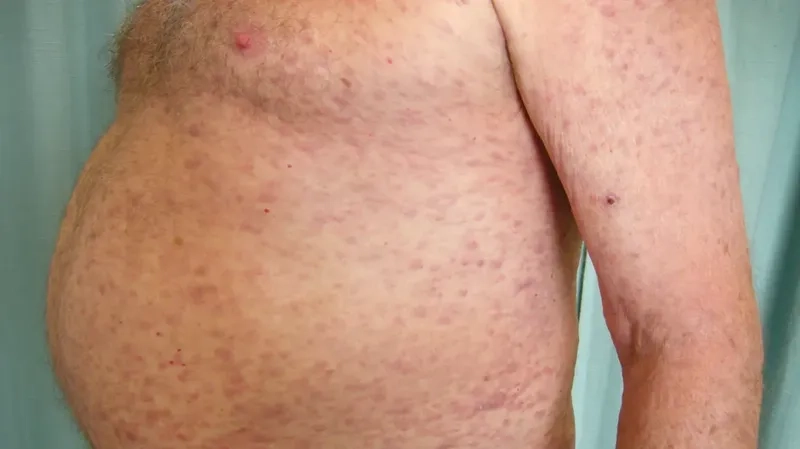 Chart showing leukemia life expectancy rates