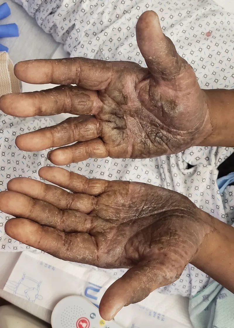 Genetic basis of chronic myeloid leukemia (CML)