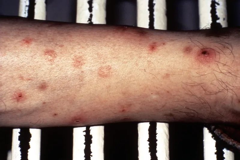 Recognizing common leukemia symptoms