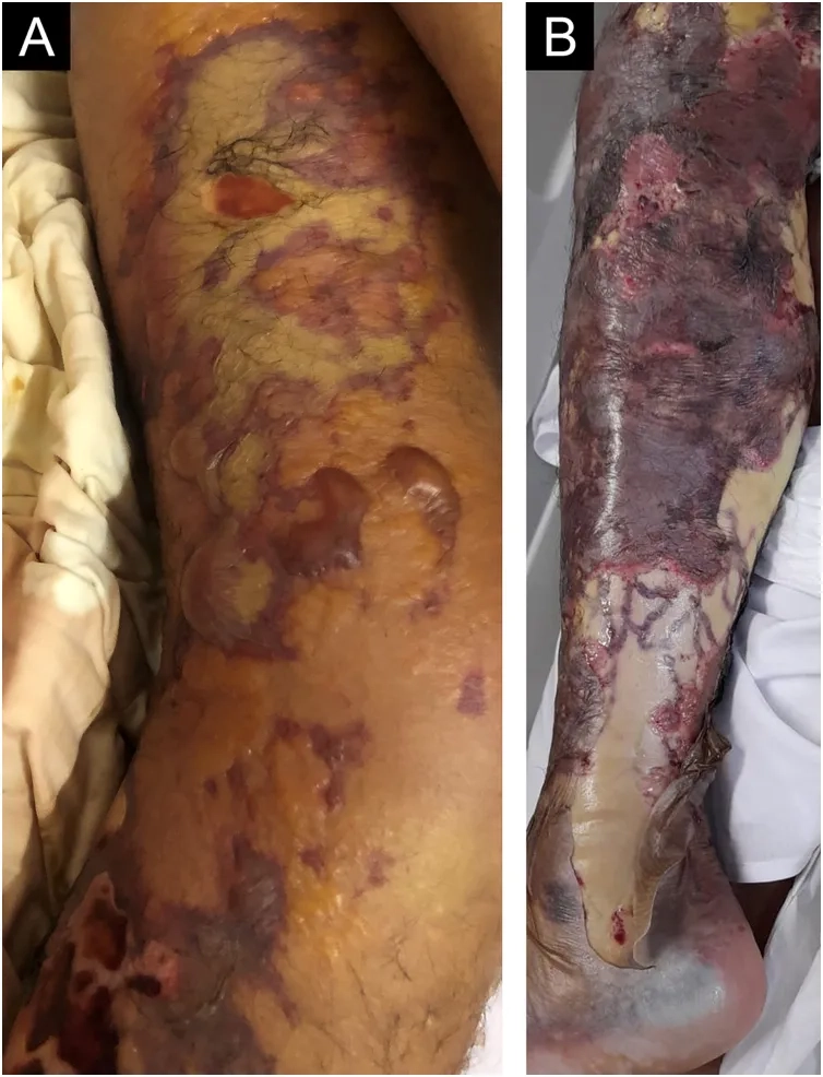 What is listeria and how do you get it