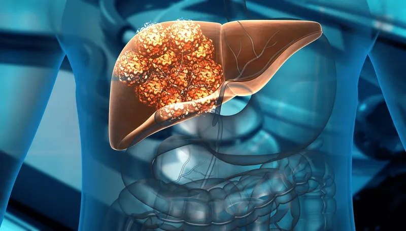 Liver cancer treatment and care options