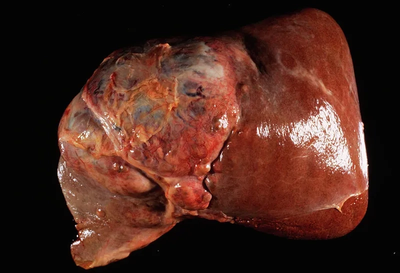 Liver metastases and secondary liver tumors