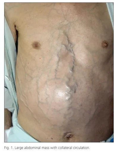 Stage 4 liver cancer and advanced condition