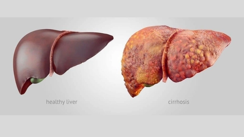 What is liver cancer hepatocellular carcinoma facts