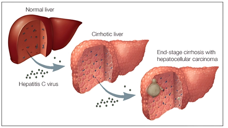 Types of liver cancer in hepatocellular carcinoma
