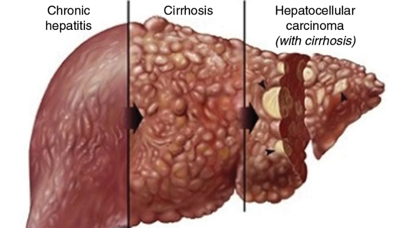 Liver cancer treatment for hepatocellular carcinoma
