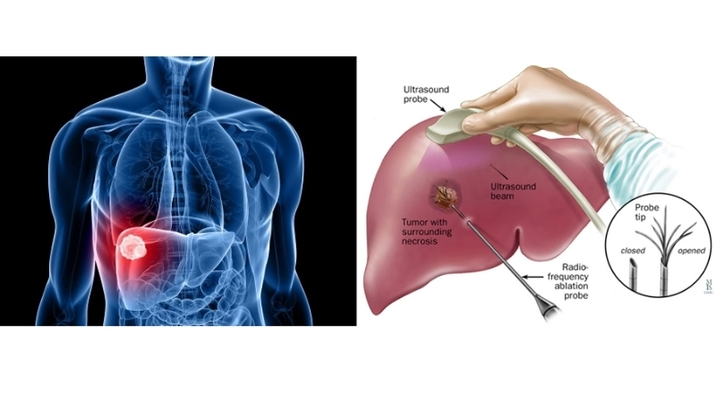 Hepatocellular carcinoma stages in liver cancer