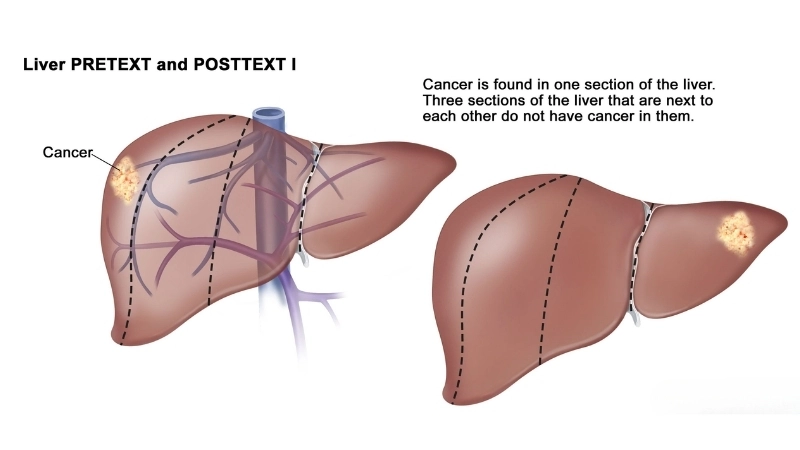 Risk factors for liver cancer hepatocellular carcinoma