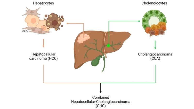 Causes of liver cancer and hepatocellular carcinoma