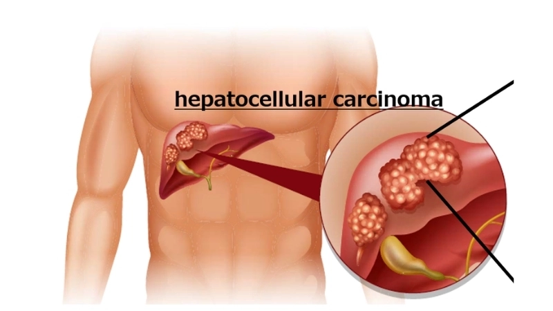 Liver cancer diagnosis in hepatocellular carcinoma