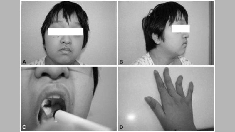 Effective strategies for Loeys-Dietz syndrome treatment