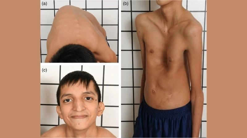Genetic insights on Loeys-Dietz syndrome genetics