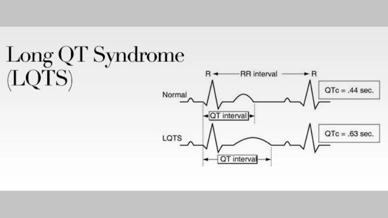Long QT Syndrome Symptoms reveal silent heart danger