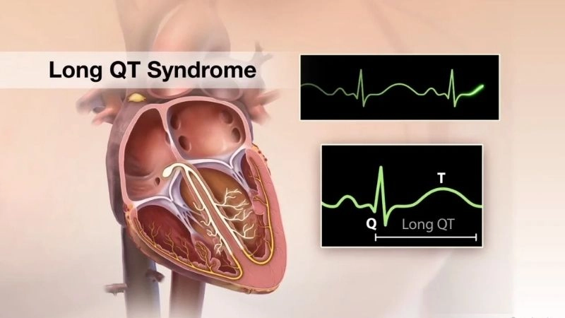 Long QT Syndrome Life Expectancy depends on care