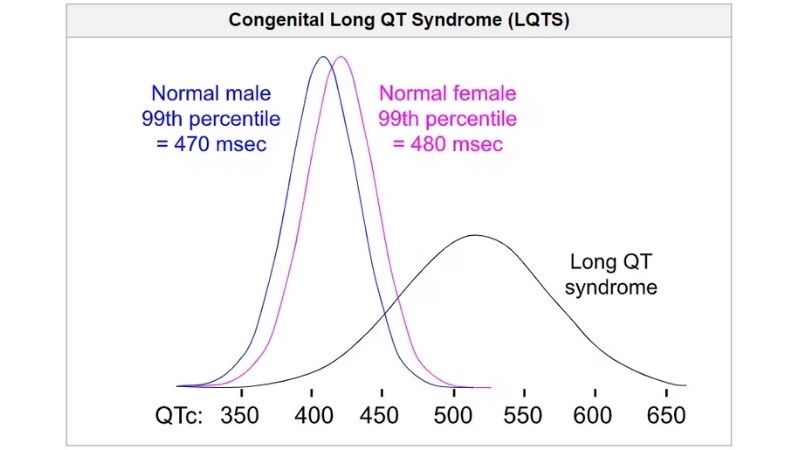 Long QT Syndrome In Children signals early warning