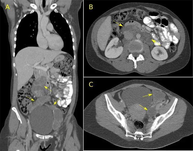 Sirolimus medication for lung conditions