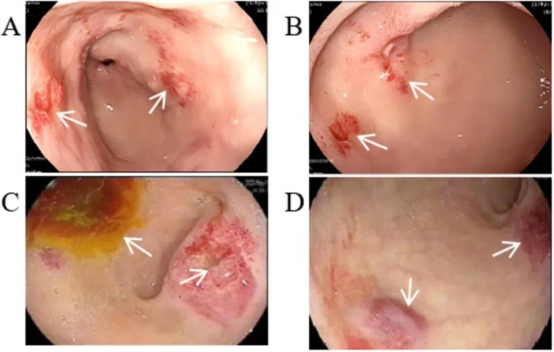 Tuberous sclerosis complex medical chart