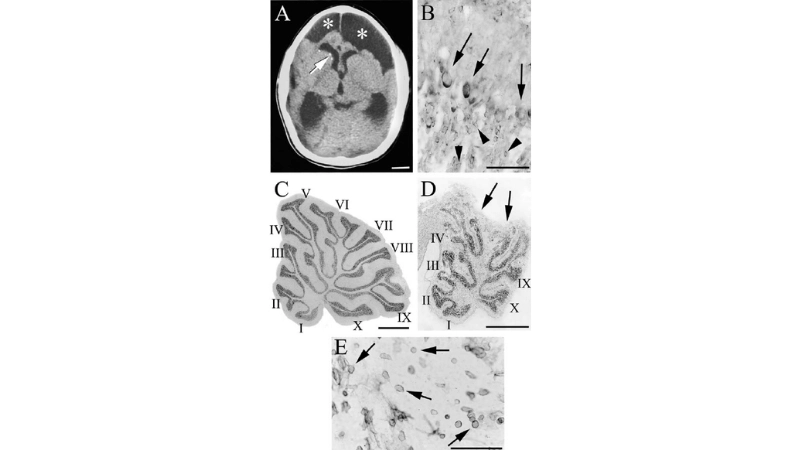 LCMV infection can trigger chorioretinitis in patients