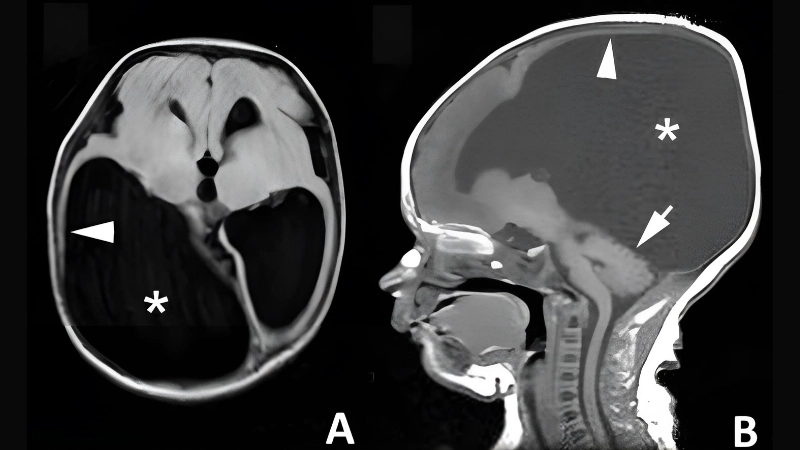 Understand viral meningitis caused by lymphocytic virus