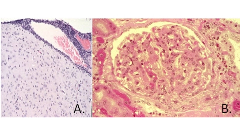Learn how congenital LCM impacts newborn brain development
