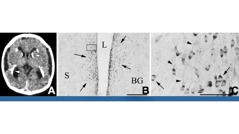 LCMV may lead to hydrocephalus in severe infections