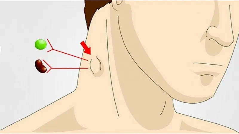 A medical chart explaining what is LGV