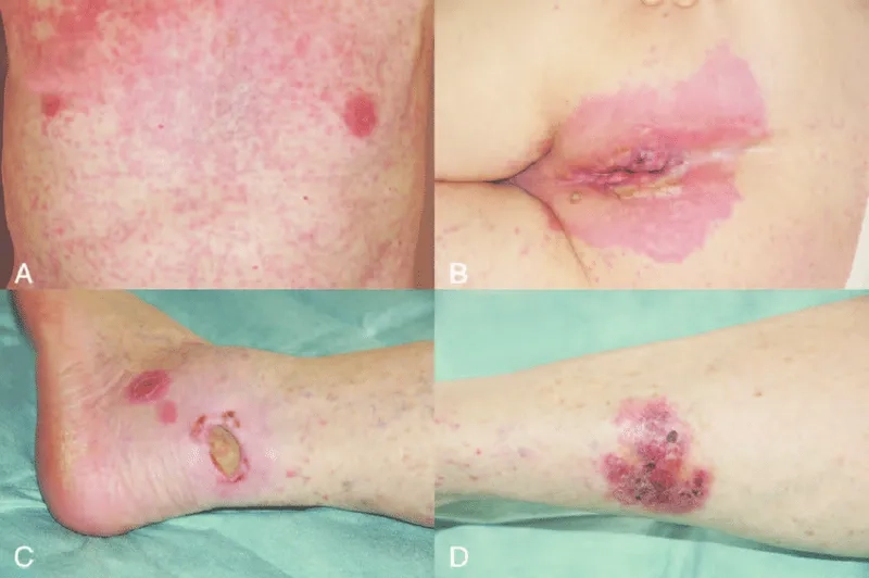A microscopic image of Hodgkin's lymphoma cells