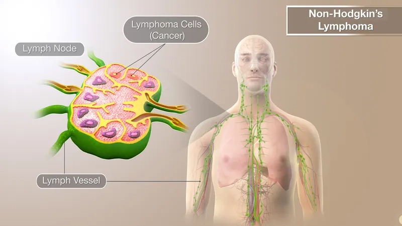 A medical chart of the most common lymphoma symptoms