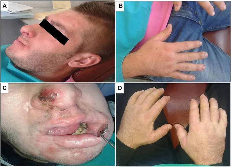 A diagram explaining what is lymphoma and how it develops