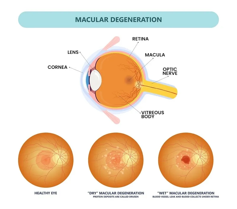Early Signs of Macular Degeneration to Watch For