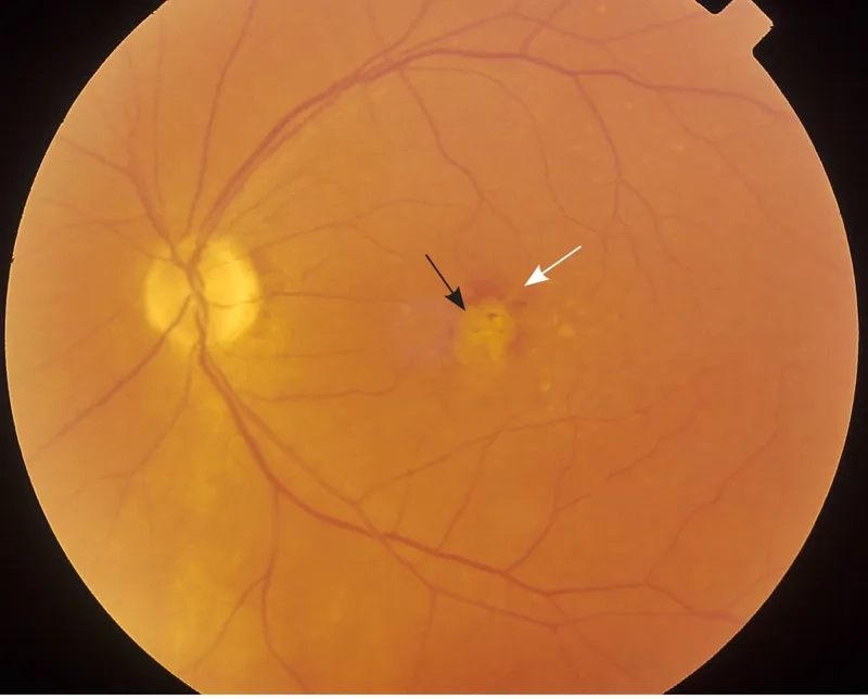 The Formulation of AREDS 2 Vitamins for Eye Health