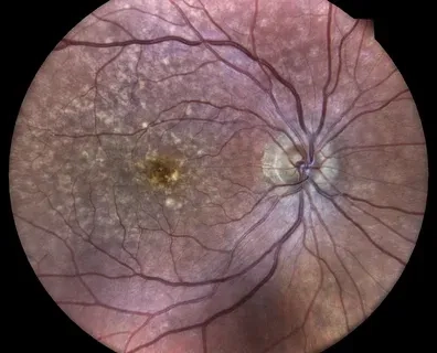 A Visual Guide to What is Macular Degeneration