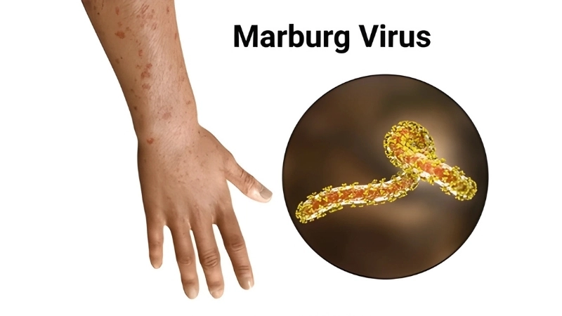 Read latest Marburg virus disease news today