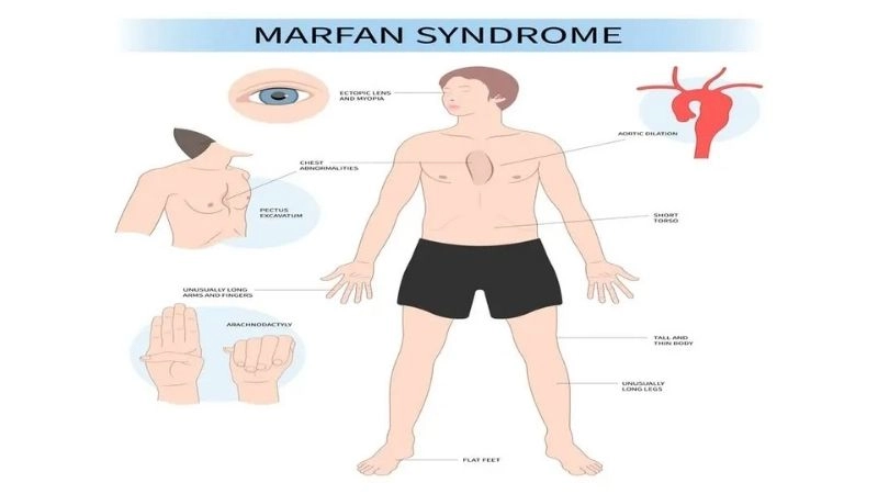 Effective approaches for Marfan syndrome treatment