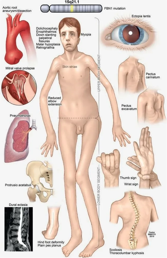 A visual guide to marfan syndrome symptoms