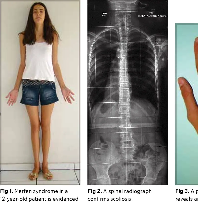 A chart showing marfan syndrome life expectancy