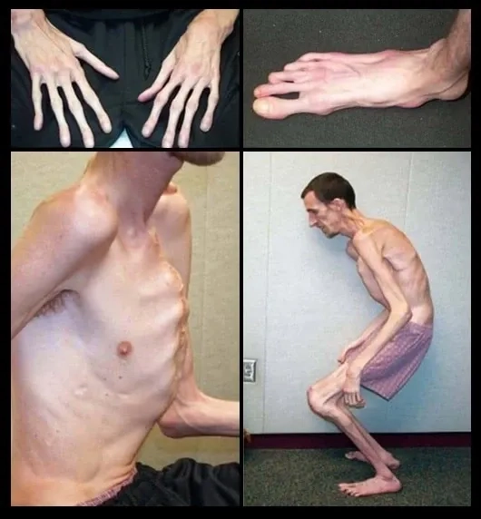 The process of a marfan syndrome diagnosis