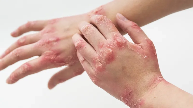 A vial of the MMR vaccine for measles mumps and rubella