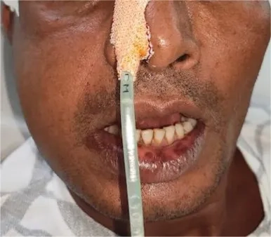 A medical chart explaining what is melioidosis