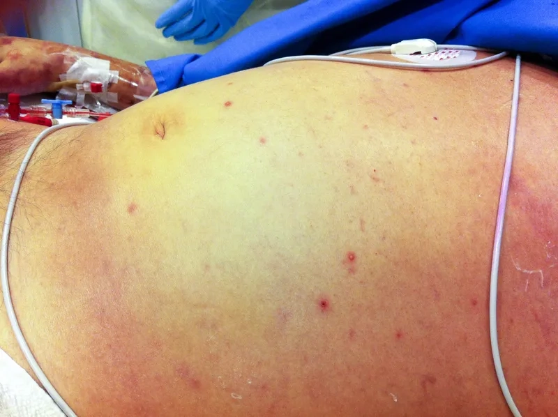 Mapping the prevalence of melioidosis in Southeast Asia