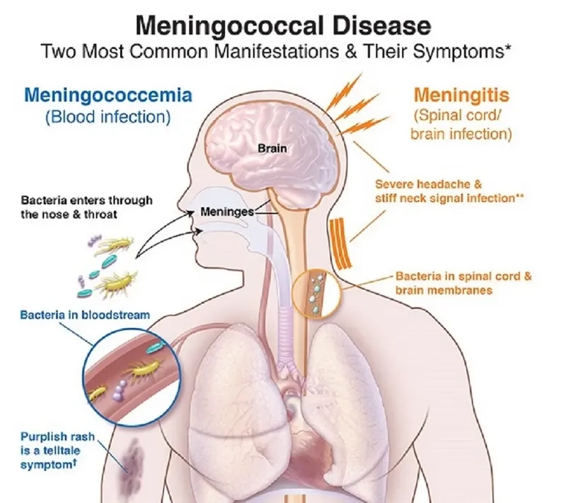 Recognizing early meningococcal disease symptoms