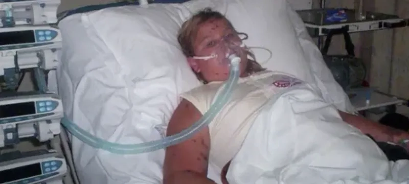 A medical illustration of what is meningococcal disease