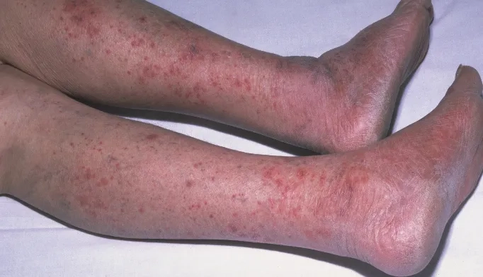 The bacterium Neisseria meningitidis under a microscope