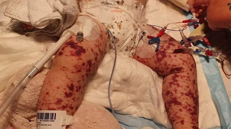 Understanding when is meningococcal disease contagious