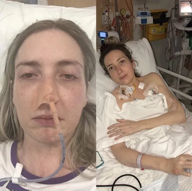 The characteristic non-blanching meningitis rash