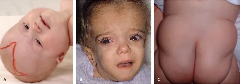 Medical chart of metabolic syndrome criteria