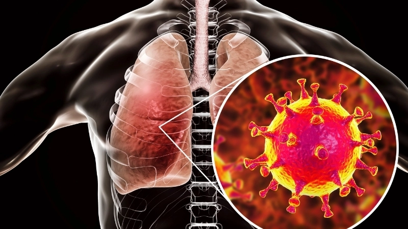 Infographic explaining the Middle East respiratory syndrome meaning
