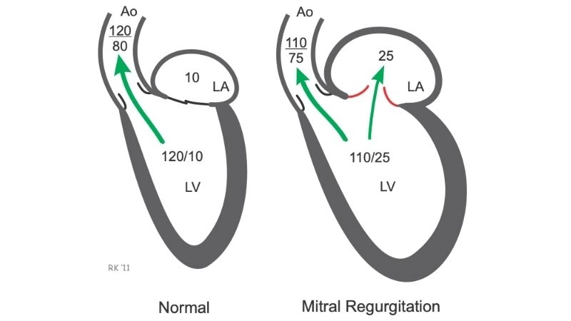 Mitral Valve Repair preserves natural valve function