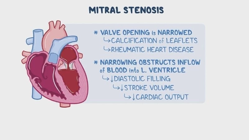 Mitral Stenosis Symptoms include fatigue and breathlessness