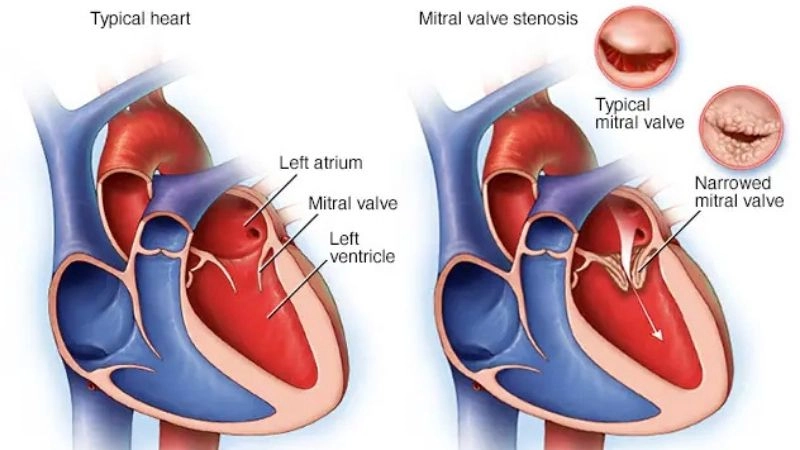Mitral Stenosis Causes often linked with rheumatic fever